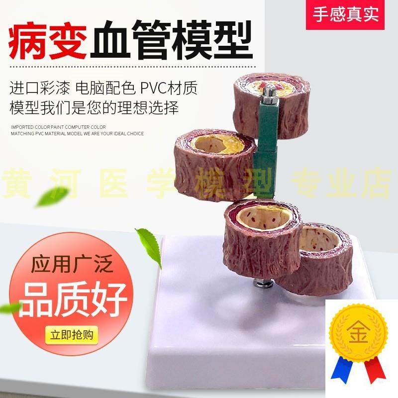 硬化支脉粥样血管模型心血管动脉解剖模型人体病U态血管模型血栓