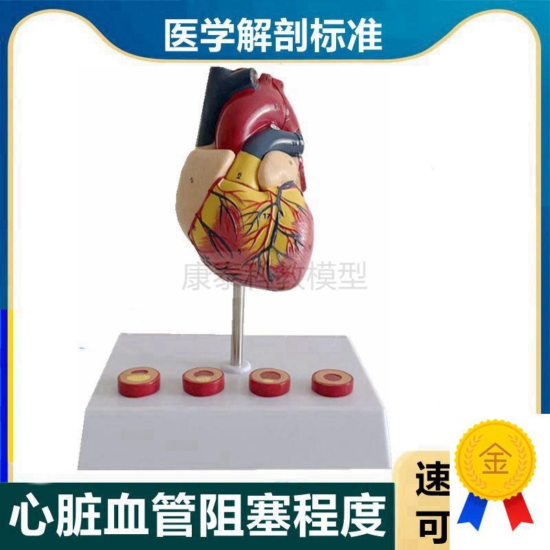 心血管模型冠状动脉粥样阻塞硬化程度狭窄脂肪斑块内膜Z栓子医患