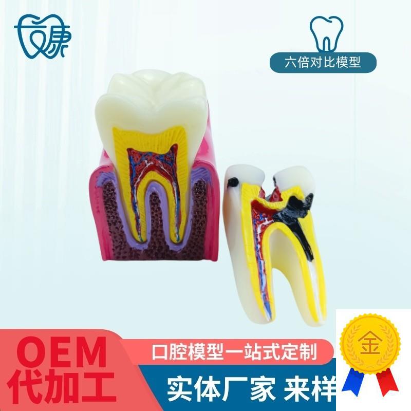 6倍对比模型牙科教学p器材6倍龋齿对比模型口腔模型教学牙齿模型