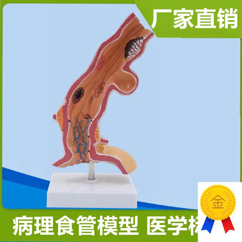 人体食管模型消j化道静脉临床医患医药礼品胃粘膜病理变化瘘道孔