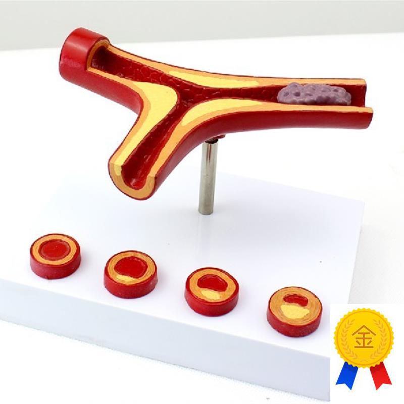 ENOVO颐诺冠状动脉性心血管动B脉硬化模型老年心脏模型血栓心内科