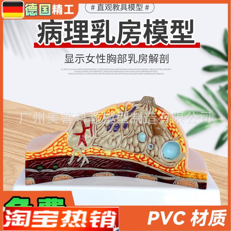 病理乳房模型 乳房病变模型 乳房解剖模型 乳房常见疾病 乳房模型