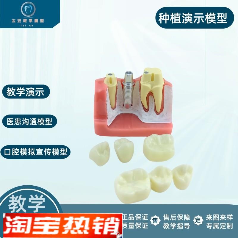 牙科口腔种植模型演示模型医患沟通教学练习种植牙模型