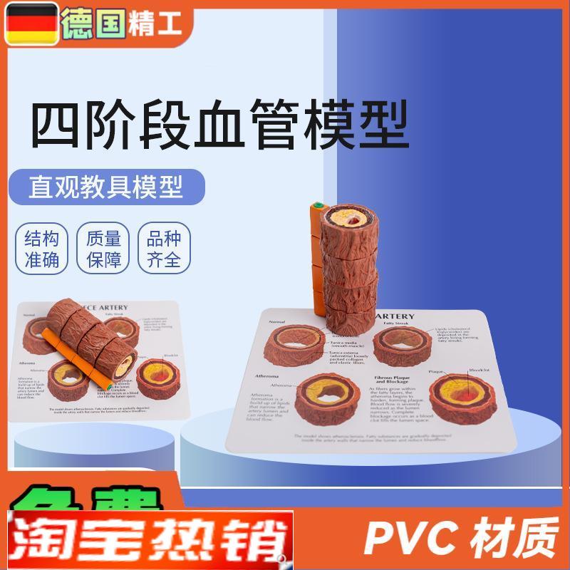 德国】血管模型人体四阶段血管标本心内科医患沟通演示血管硬化模