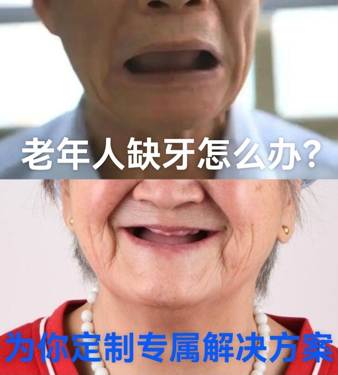 老年人缺牙半口全口活动假牙吸附性义齿咨询 - 实物图