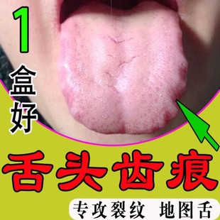 舌头有齿痕发白舌苔厚舌裂纹肿痛发炎地图舌溃烂长泡口腔扁平苔藓