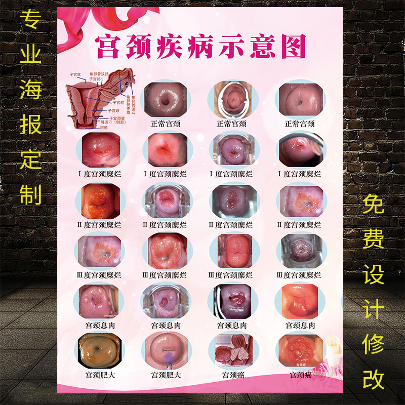 宫颈疾病示意图妇科墙贴病变级别海报炎症子宫图片美容院挂图广告
