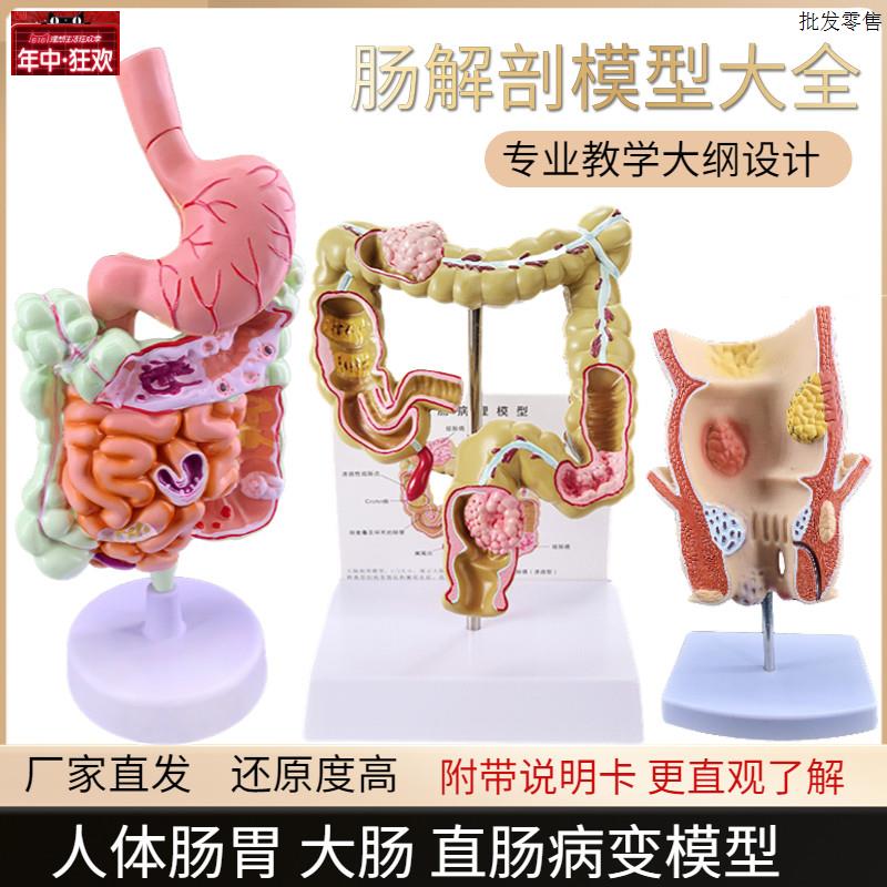 大肠病理模型肠胃病变解剖模型直肠模型肠道疾病T人体结肠病理模