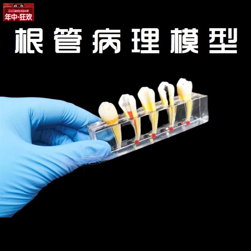 牙科口腔教学模型蛀牙龋坏发展演示水晶根管成人m病理模型牙齿展