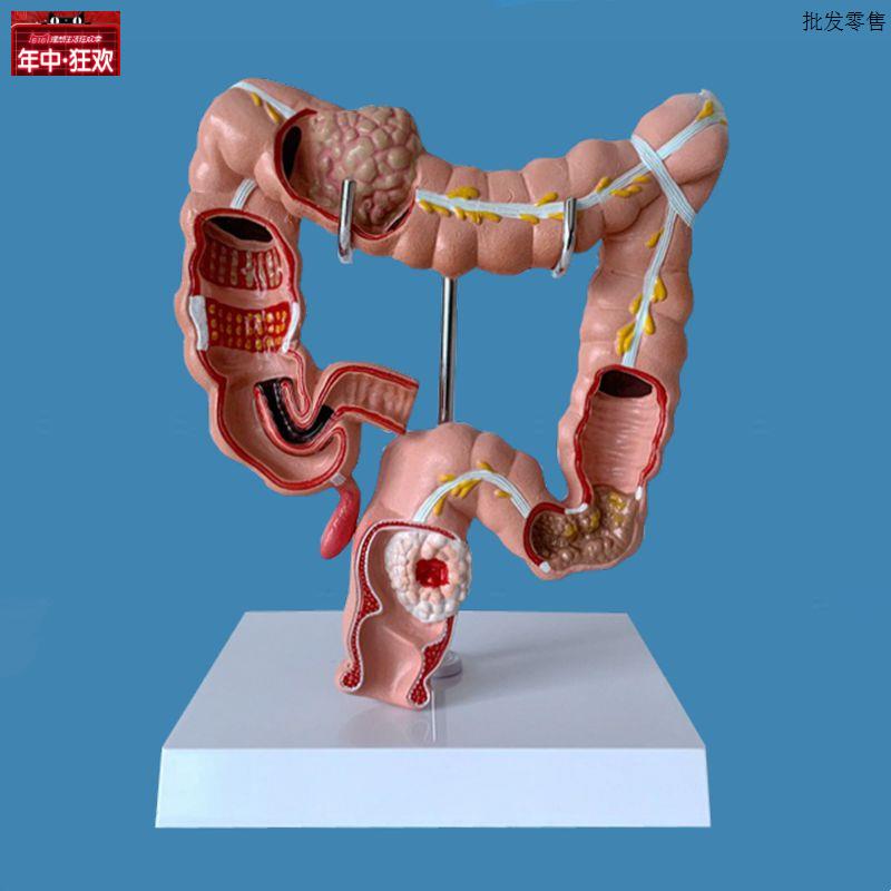 大肠模型结肠病例肠道扭转盲肠P阑尾直肠肛管消化道肛肠科医药促