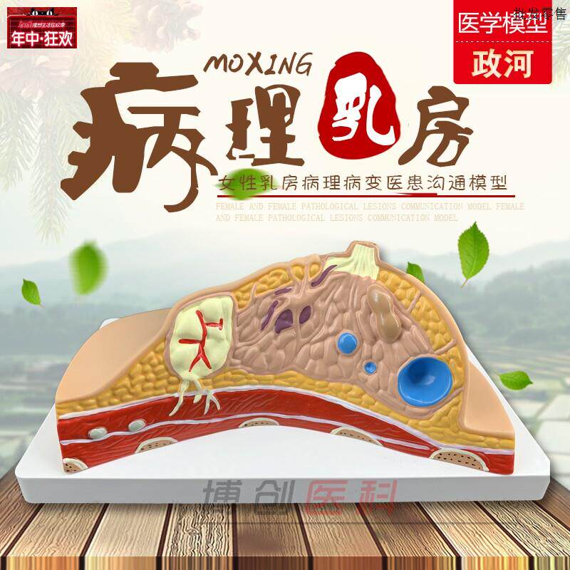 正品乳房常见疾病模型V乳房病理解剖结构模型乳房模型妇科模型