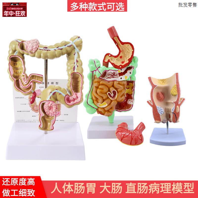 大肠病理.模型直肠模型肠胃病变解剖模型肠道疾病人体结肠病变模