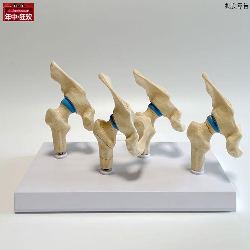 髋关节模型股骨颈骨折软骨损伤骨科G医药促销医患示教髋骨肌肉功