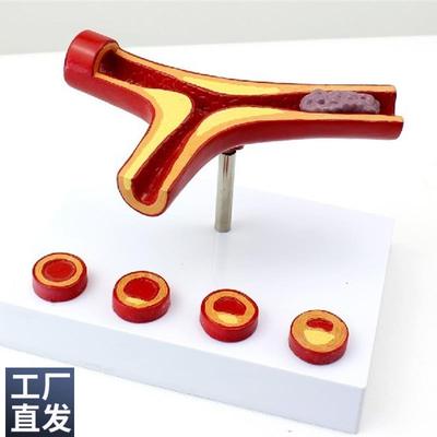 ENOVO颐诺冠状动脉性心血管动脉硬化模型 老年心脏模型血栓心内科