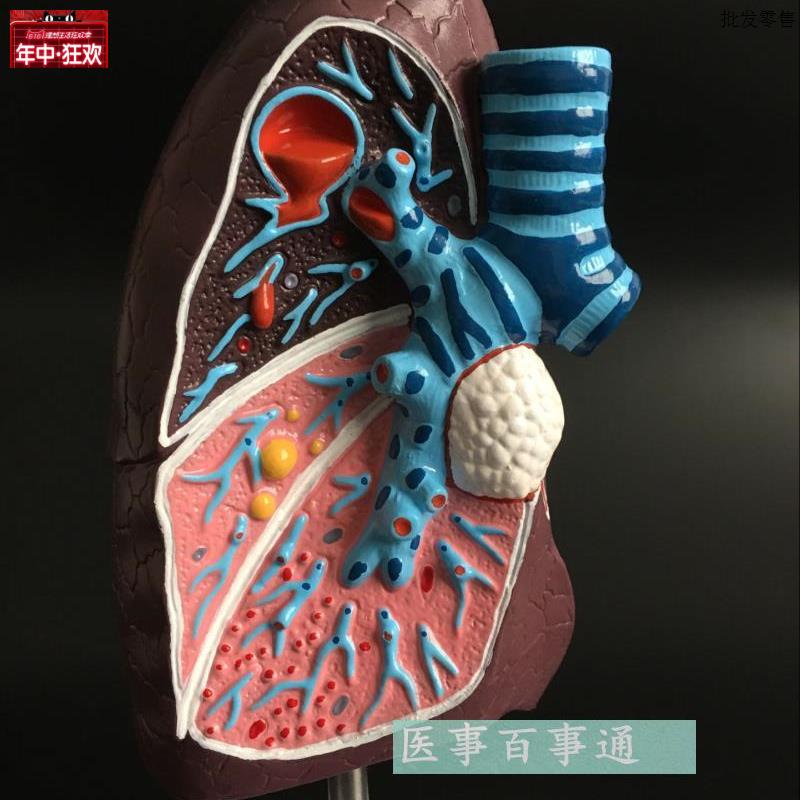 人体肺解剖模k型,肺部模型,病态肺模型,人体病变肺解剖模型内脏