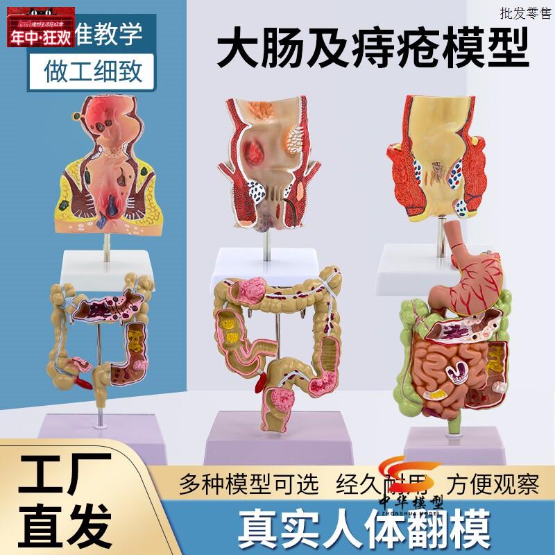 大肠病理模型直肠模型肠胃病变解剖模型肠道疾J病人体结肠病变模