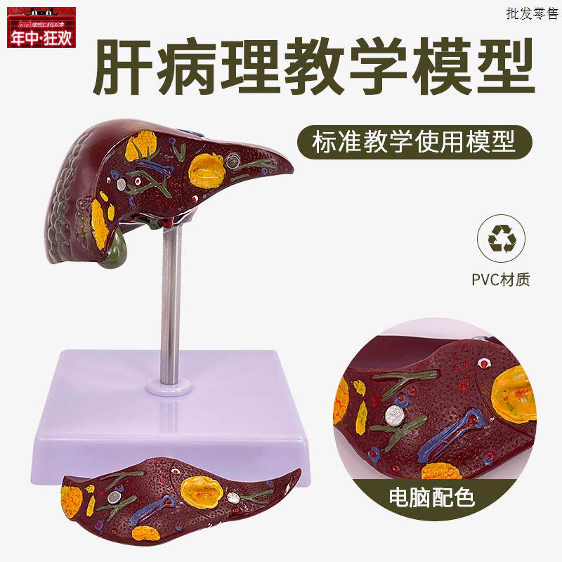 肝脏病理模型脂肪/肝肝o梗化肝bing变肝胆人体肝脏解剖模型