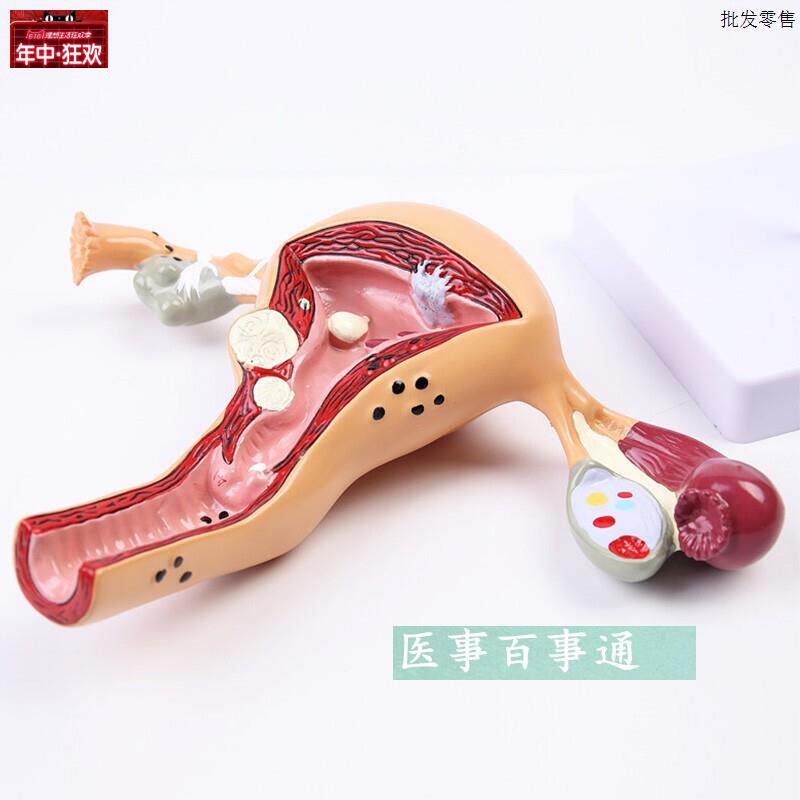 子宫卵巢常见病模型女性生殖系统C计生模型教学医用模型子宫模型