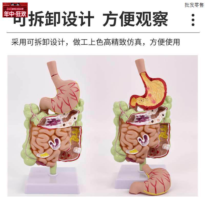 人体大肠病理模型直n肠结肠病变解剖肠胃疾病教学演示医用模型
