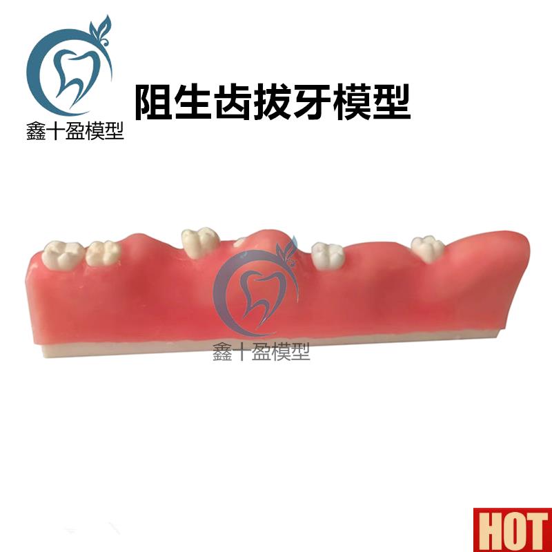 科阻生齿拔牙模型牙齿模型口腔教学仿真口腔护理牙医R诊所牙齿病