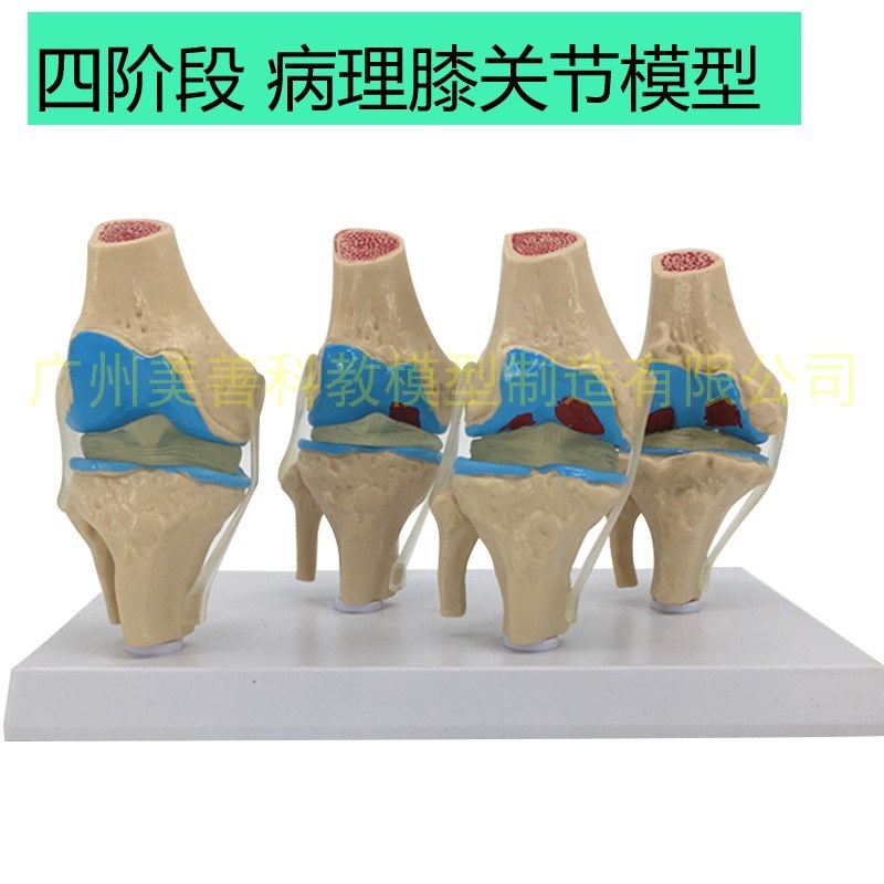 病态膝关节模型i 病理膝关节模型 病变膝关节模型 退行性关节