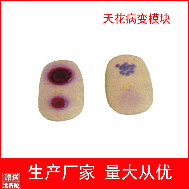 天花病变模块护理模型天花病毒检查模型医学教S学模型护士实习用