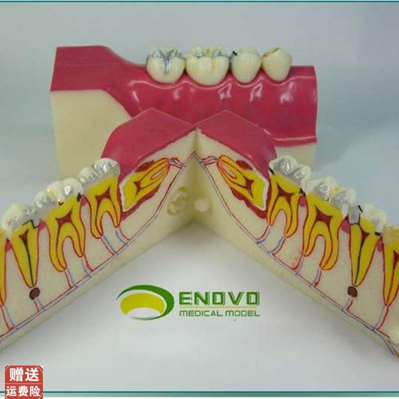 ENOVO颐g诺右下后牙组织分解模型牙齿解剖牙列模型口腔齿科科教学,文具电教/文化用品/商务用品,教学标本/模型,淘宝优惠券,粉丝福利购,淘宝优惠卷