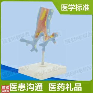 病理支气管模h型细支气管支气管树喉气管人体呼吸道医患教育