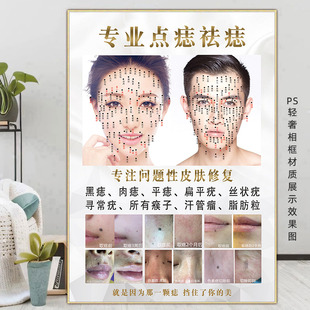 祛痣宣传画点痣广告图kt板男女面痣图取痣挂画痣相图祛斑祛疣海报