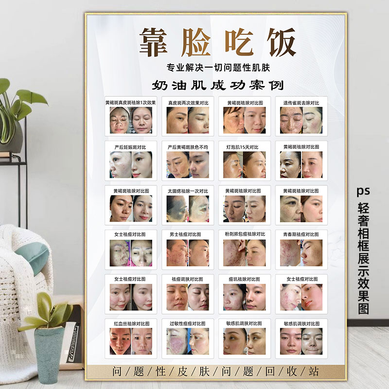 祛斑祛痘海报斑痘敏装饰祛痣挂画