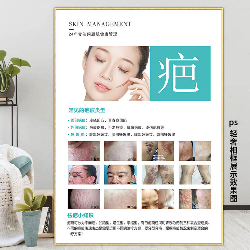 祛疤海报祛斑祛痘广告图点痣图片美容院斑痘敏疤痕修复宣传壁画kt