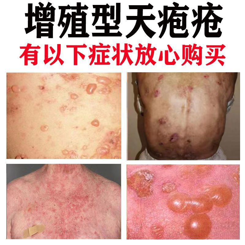 寻常型天疱疮克星增殖型落叶型红斑型头藓糜烂脓包瘙痒专用药膏