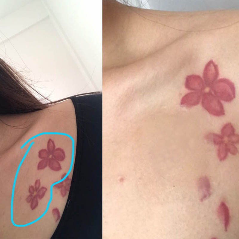 毛孔痘印疤痕贴持久遮瑕膏