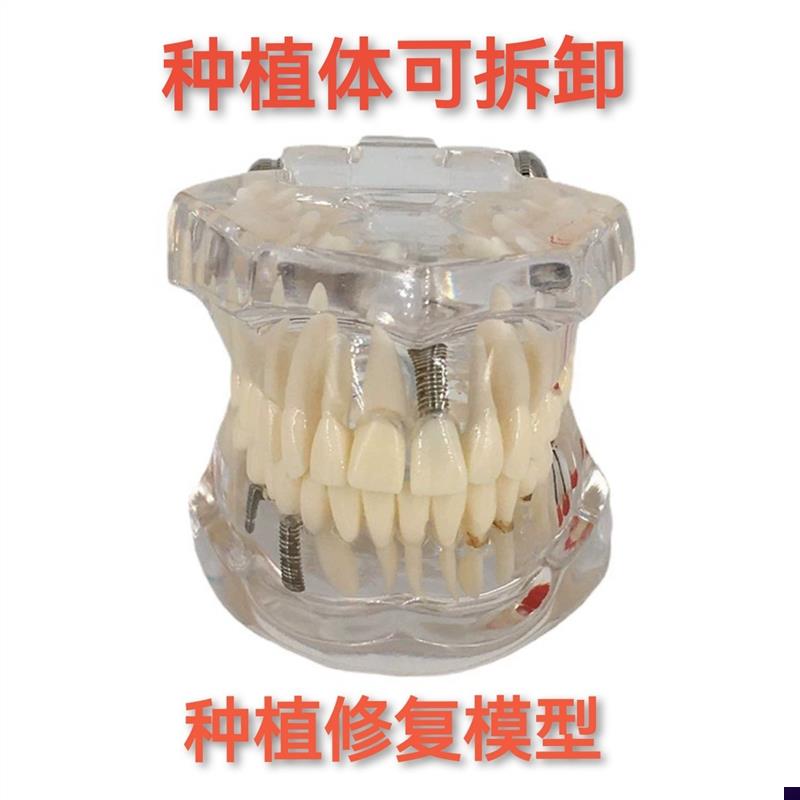 牙科材料修复牙模型水晶病理牙H模型活动种植牙模型包邮
