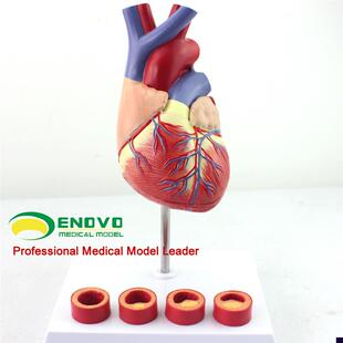 颐诺正品1:1医用人体心脏模型动脉粥样硬化模型U血栓心内科教学