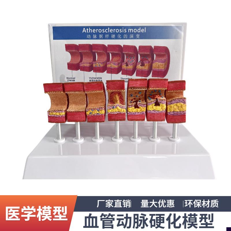 7节动脉粥样硬化模型血管血栓栓塞演示模型人体血管X模型医用教具