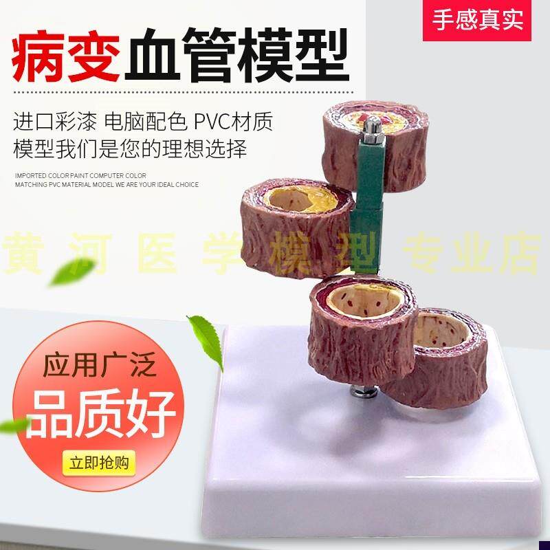 硬化支脉粥样血管模型心血管动脉解剖模型人体病T态血管模型血栓