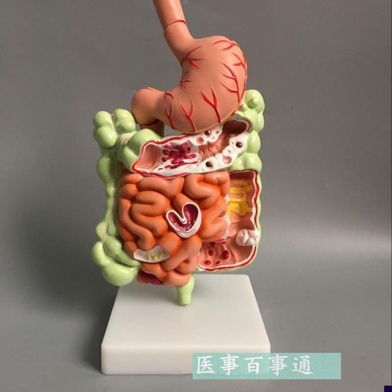 大肠病理模型大肠模型大肠病变模型肠K道疾病结肠病变模型包邮