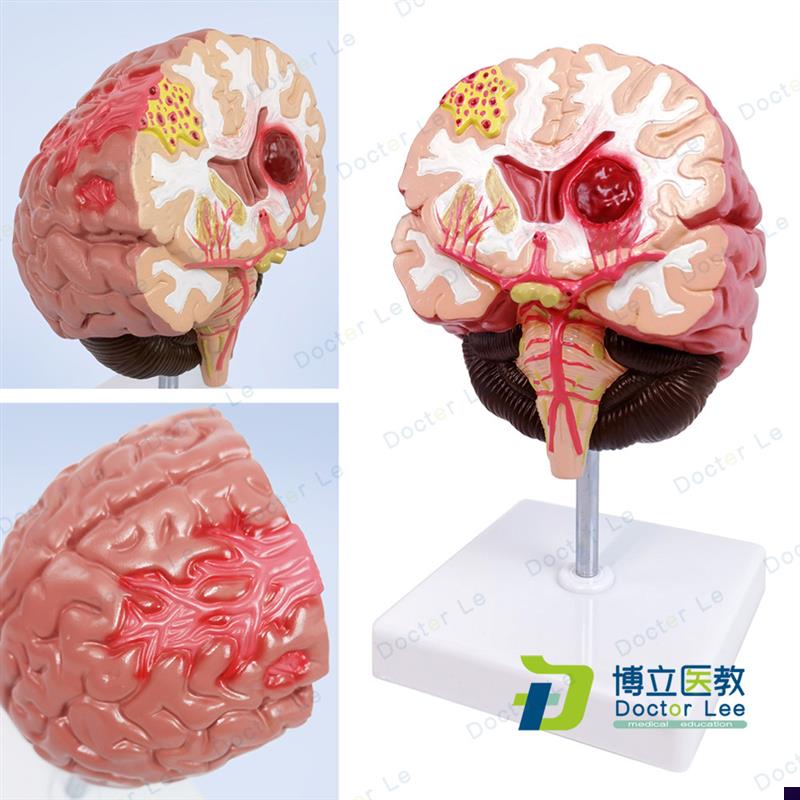 人体脑解a剖脑病理疾病脑病理构造脑(血管)病变脑模型