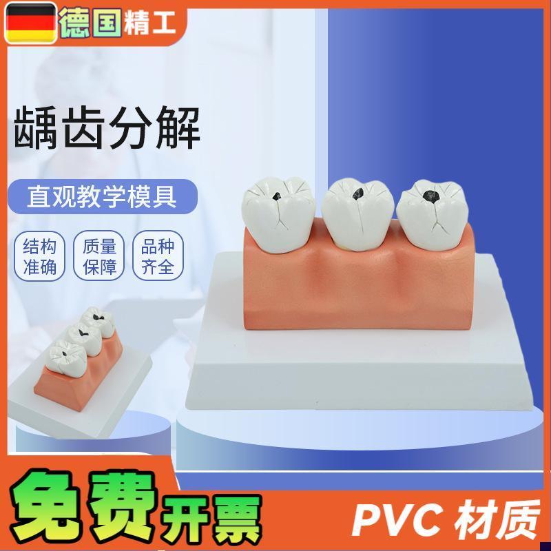 德国】龋齿病分解解剖模型牙齿模型口腔牙保健护理模.型牙科牙齿