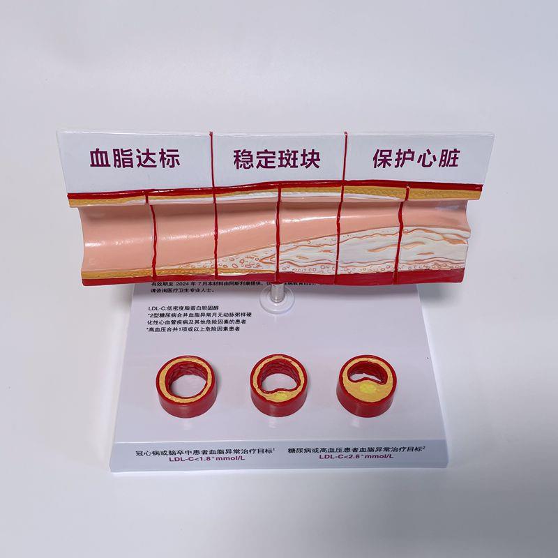 病理心血管模型粥样硬化脂肪斑块D动脉内膜受损程度医药促销礼品