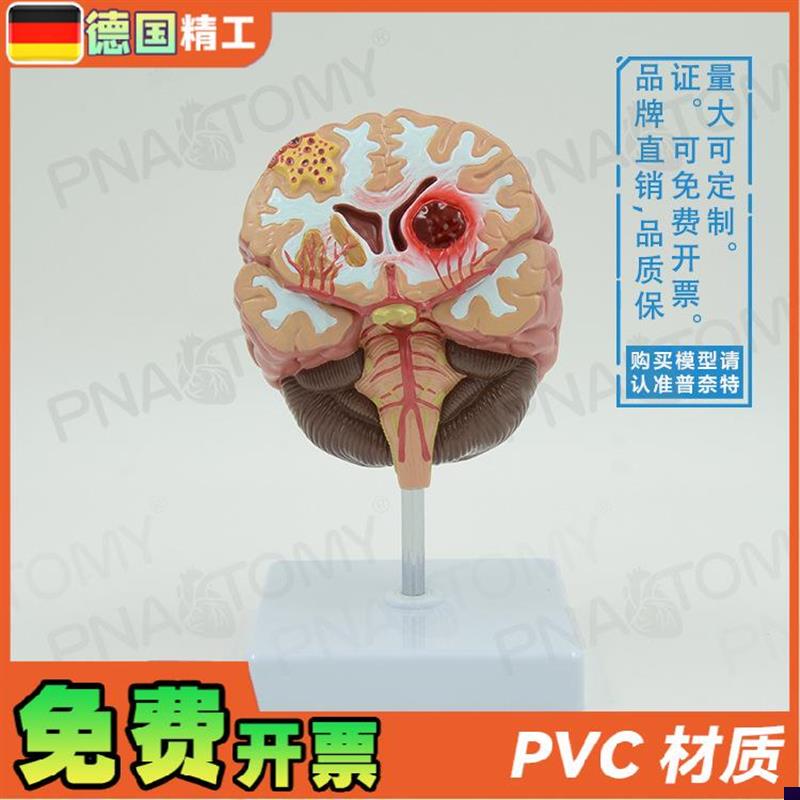 德国】人脑病理解剖模型脑gveng大脑疾病血管堵塞标本教学脑科神