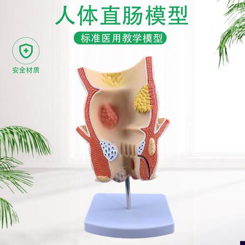 痔疮直肠病理模型溃杨性结v肠病肠直肠解剖病理模型病态疾病教具