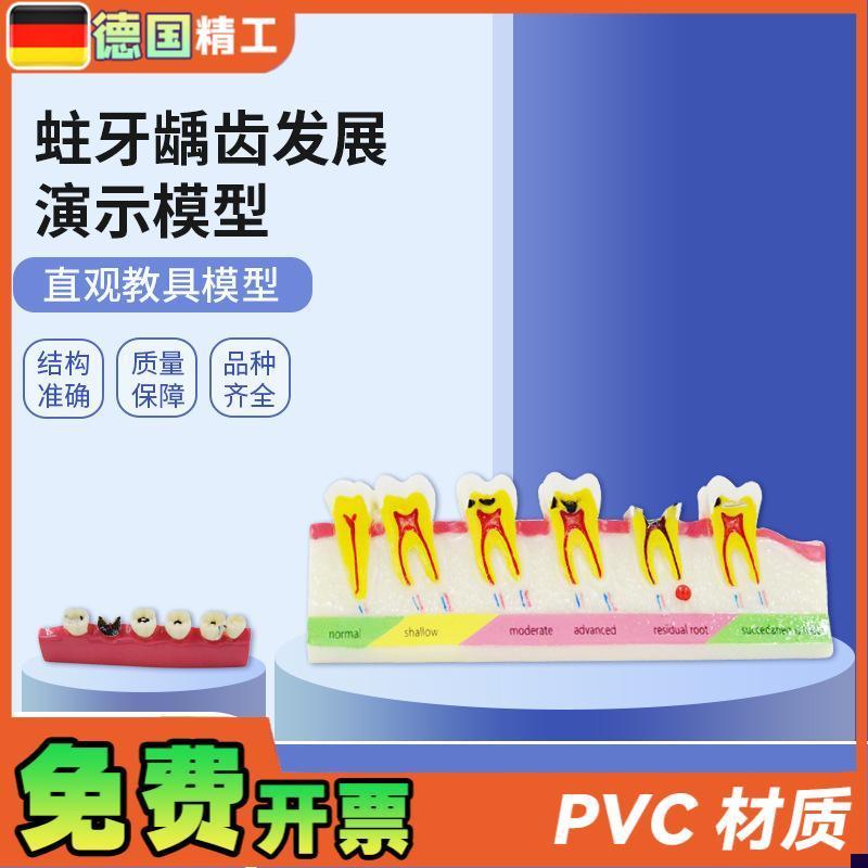 德国PNT-OR1l0蛀牙龋齿模型牙科口腔教学模型牙周炎演变模型蛀牙