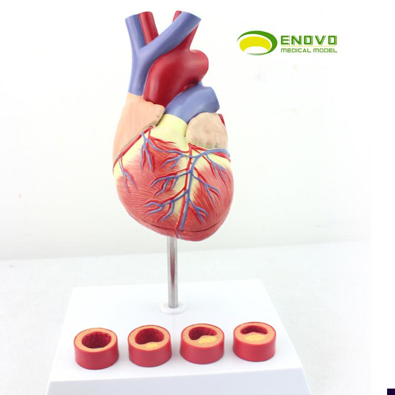 ENOVO颐诺1:1医学人体心脏模型冠状动脉血栓心内W科教学动脉粥样