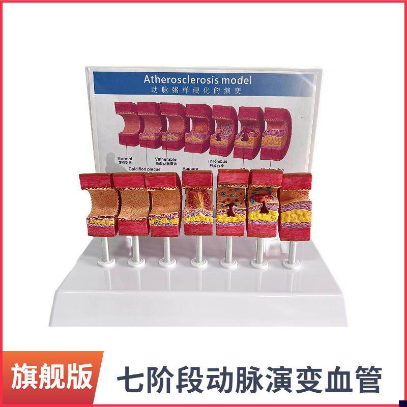 动脉粥样硬化模型血管血栓栓塞模型动脉血管O人体医用医学教学教