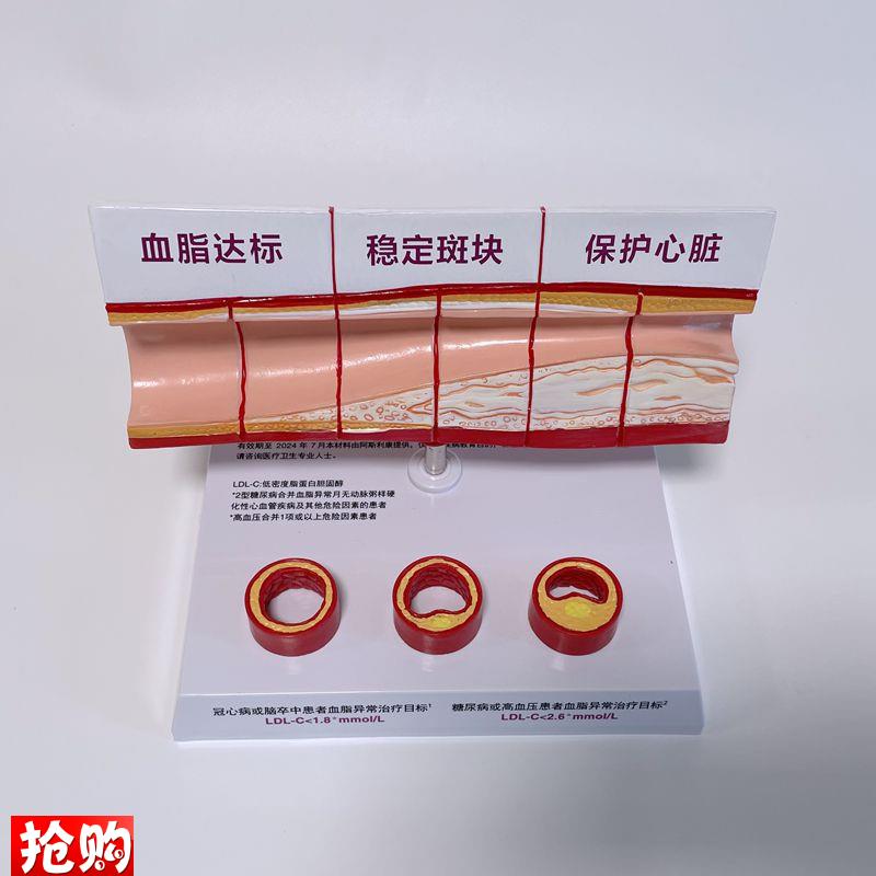 病理心血管模型粥样硬r化脂肪斑块动脉内膜受损程度医药促销礼品