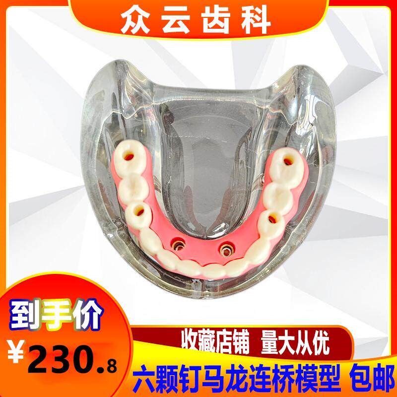 牙科种植体修复模型种植钉球帽结合D半口综合病理种植与无牙颌模