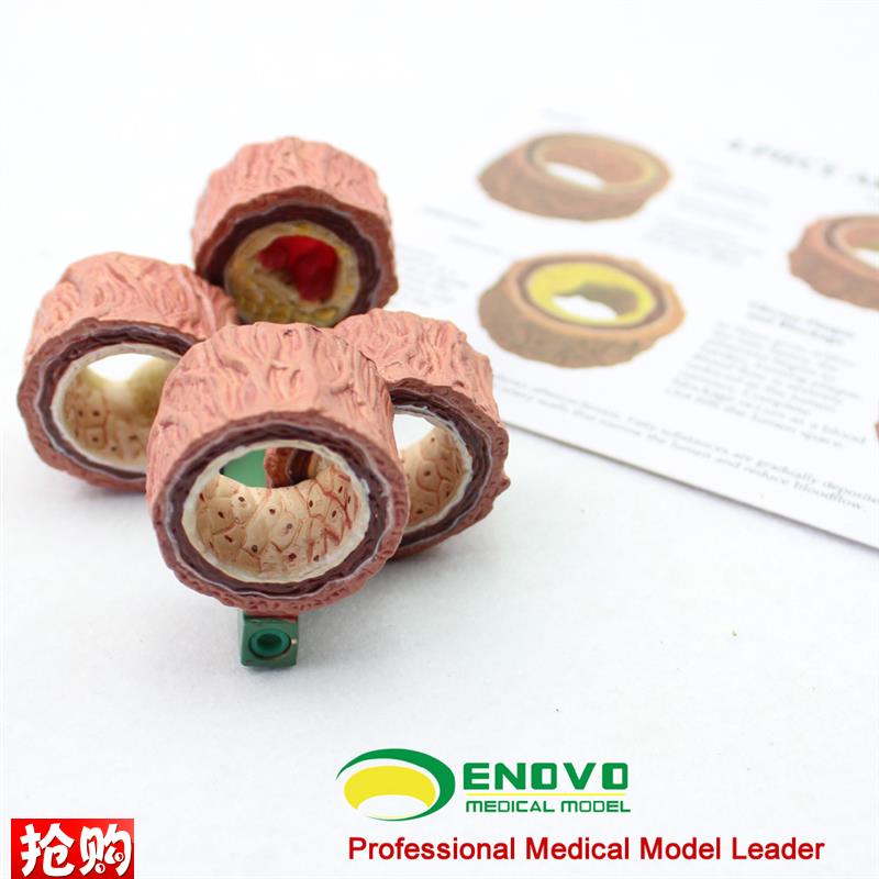 颐诺正品动脉g粥样硬化模型血栓病变模型心血管模型内科学