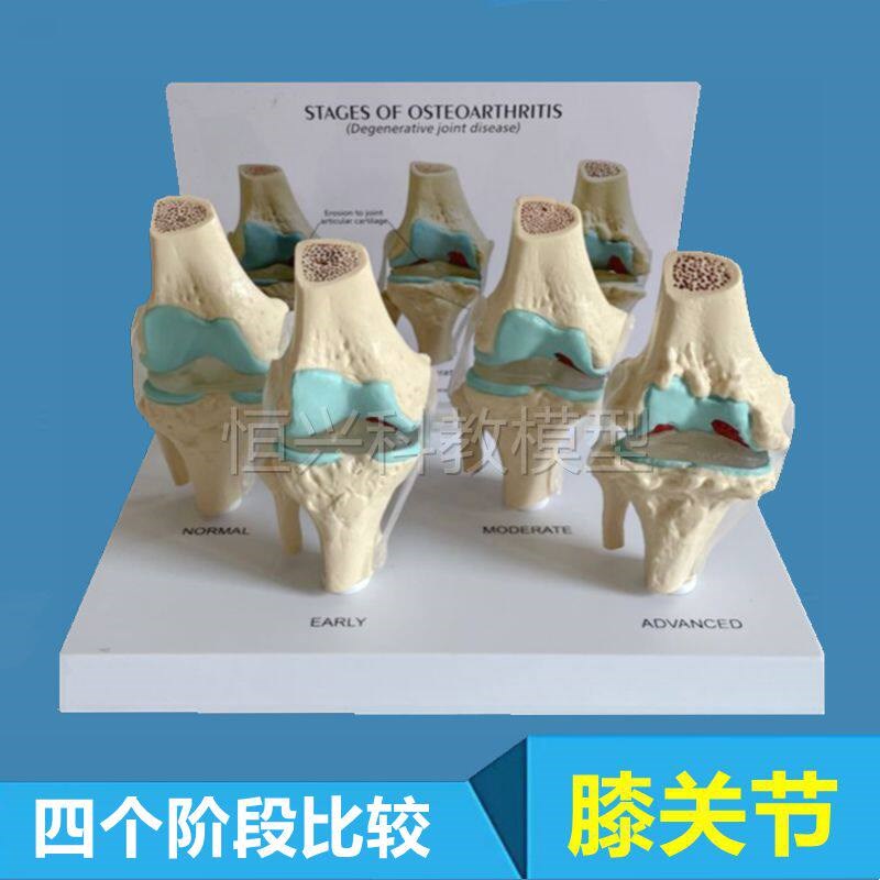 膝盖半月板软骨骨赘人体膝关节病B理磨损替换韧带骨科医药促销医